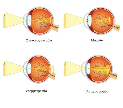 Τι είναι μυωπία; Οφθαλμίατρος χειρουργός Σέρρες